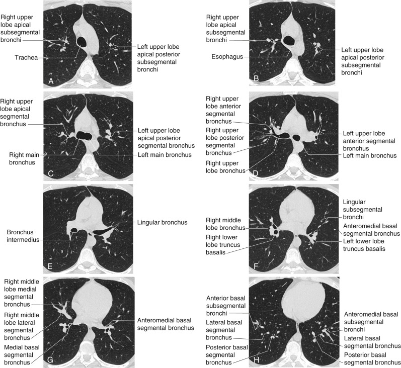 FIGURE 2.1, Airway anatomy. A, Axial computed tomography (CT) image at the level of the aortic arch shows the trachea and subsegmental branches of the apical bronchus in the right upper lobe and apical posterior subsegmental bronchi in the left upper lobe.