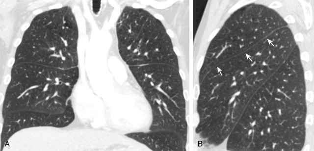 FIGURE 2.13, Left minor fissure. A, Coronal computed tomography (CT) image shows the left minor fissure at approximately the same level as the right minor fissure. B, Sagittal CT image shows the left minor fissure separating the lingula from the remainder of the left upper lobe (arrows) .