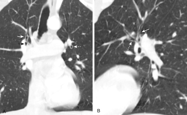 FIGURE 2.2, Upper lobe anterior segmental bronchi. A, Coronal computed tomography (CT) image shows the anterior segmental bronchi of the right and left upper lobes. The apical segmental bronchus in the right upper lobe is seen at the same level and ascends superiorly (white arrow). The anterior segmental bronchus is located just lateral to the truncus anterior (black arrow) , and the left upper lobe anterior segmental bronchus is visible end-on (dashed arrow) . B, Sagittal CT image through the left lung shows that the apical posterior segmental bronchus extends superiorly in the left upper lobe (arrow) , while the anterior segmental bronchus courses anteriorly (dashed arrow) .