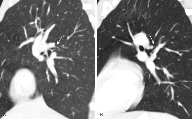 FIGURE 2.3, Lower lobe superior segmental bronchi. A, Sagittal image through the right lung shows the origin of the right lower lobe superior segmental bronchus (arrow) . B, Sagittal computed tomography image through the left lung shows the origin of the left lower lobe superior segmental bronchus (arrow) .