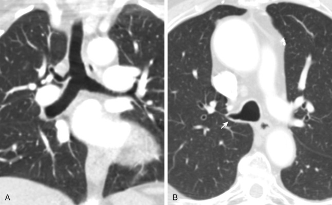 FIGURE 2.4, Tracheal bronchus. A, Coronal computed tomography (CT) image demonstrates the tracheal bronchus arising from the lateral wall of the trachea and supplying the apical segment of the right upper lobe. The tracheal bronchus is seen just below the azygous arch. B, Axial CT image from a different patient shows the tracheal bronchus origin from the right lateral aspect of the distal trachea (arrow) .