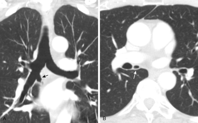 FIGURE 2.5, Accessory cardiac bronchus. A, Coronal computed tomography (CT) image demonstrates a blind-ending bronchial diverticulum arising from the medial wall of the bronchus intermedius (arrow) . There is no associated pulmonary parenchymal tissue in this patient. B, Axial CT image shows the accessory bronchus coursing inferiorly (arrow) , roughly parallel to the bronchus intermedius.