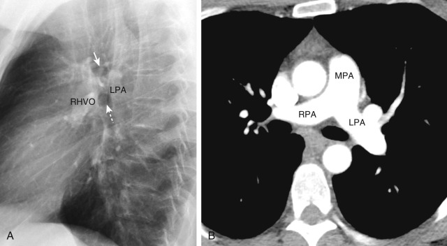 FIGURE 2.6, Hilar anatomy. A, Lateral chest radiograph shows the normal relationship between the hilar structures. The right upper lobe bronchus (white arrow) is seen as an ill-defined oval lucency anterior to the left pulmonary artery (LPA) and posterior to the aortic arch. The right hilar vascular opacity (RHVO) is an anterior round poorly marginated density. The left main–upper lobe continuum (LULC) (dashed arrow) is typically seen as a well-delineated round lucency inferior to the right upper lobe bronchus and anterior to the LPA. B, Axial computed tomography (CT) image shows the main pulmonary artery (MPA) and demonstrates the shorter mediastinal course of the left pulmonary artery compared with the right pulmonary artery (RPA). C, Sagittal CT image shows the right pulmonary artery (RPA) located posterior to the ascending aorta (A). D, Sagittal CT image shows the left pulmonary artery arching posteriorly and laterally over the LULC (asterisk) , which creates the comma-shaped opacity on the lateral radiograph.