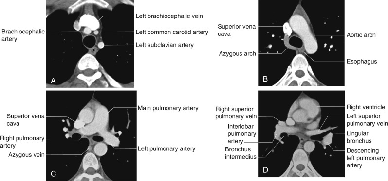 FIGURE 2.7, Pulmonary vessels. Sequential computed tomography images demonstrating normal mediastinal and hilar vascular anatomy. A, At the level of the left brachiocephalic vein, the three arterial branches arising from the aortic arch can be seen: the brachiocephalic artery, left common carotid artery, and left subclavian artery. B, At the level of the aortic arch, the azygous vein can be seen draining into the superior vena cava. C, The main pulmonary artery bifurcates into the right and left pulmonary arteries as shown. D, At the level of the superior pulmonary veins, the interlobar artery is seen lateral to the bronchus intermedius. The descending left pulmonary is located posterior and lateral to the lingular bronchus.