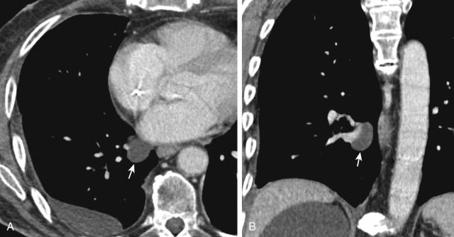 FIGURE 2.9, Right pulmonary venous recess. Axial (A) and coronal (B) computed tomography images show fluid in the right pulmonary venous recess (arrows) adjacent to the right inferior pulmonary vein. This is a common pseudolesion that may be mistaken for lymphadenopathy.