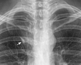 FIGURE 2.10, Accessory azygous fissure. Posteroanterior radiograph demonstrates the curvilinear accessory azygous fissure as it courses inferiorly to terminate above the right hilum. The teardrop-shaped opacity seen along the inferior aspect of the fissure represents the azygous vein (arrow) .