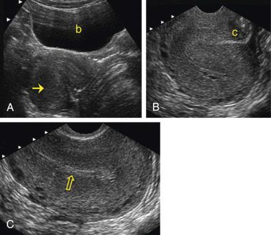 FIG 26-2, Improved visualization of the uterus with transvaginal imaging. A, Longitudinal transabdominal sonogram of a retroflexed uterus performed through a full urinary bladder (b). The endometrial canal ( arrow ) in the body of the uterus is not well seen as it lies parallel to the ultrasound beam. B, Transvaginal sonogram of the same patient. The cervix (c) is interposed between the transvaginal probe and the body of the uterus. This gives suboptimal visualization of the myometrium and endometrial canal. C, Transvaginal sonogram of the body and fundus of the uterus after the probe has been repositioned beyond the cervix and angled posteriorly. The probe now lies immediately adjacent to the retroflexed uterus, providing much improved visualization of the endometrium ( open arrow ).