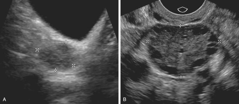 FIG 26-3, Improved characterization of ovarian morphologic appearance with transvaginal imaging. A, Longitudinal transabdominal scan of the right ovary ( calipers ) provides little anatomic detail. B, Transvaginal scan of the right ovary ( calipers ) in the sagittal plane demonstrates multiple small peripheral anechoic follicles and central echogenic stroma in this patient with polycystic ovary syndrome.