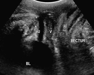 FIG 26-4, Transperineal image of the urethra. Longitudinal image obtained by placing the probe on the perineum shows a normal urethra (U), which appears as a nearly anechoic linear channel arising from the bladder cephalad and parallel to the vagina (V) in this patient with symptoms concerning for lower urinary tract disease. BL, urinary bladder.