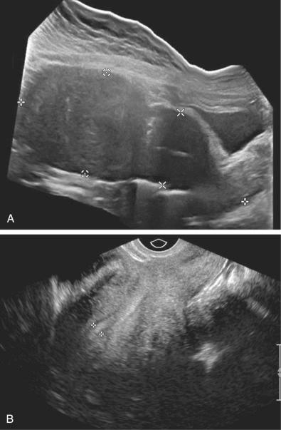 FIG 26-5, Pelvic mass only visible on transabdominal sonography. A, Longitudinal midline extended field of view transabdominal sonogram of the uterus demonstrates a large fundal leiomyoma ( calipers with central dot ) extending to the level of the umbilicus. Measurement of the uterus includes the large leiomyoma ( calipers ). B, Longitudinal transvaginal image does not image the leiomyoma, as it was located above the uterine fundus, beyond the field of view of the transvaginal probe. Calipers show endometrium.