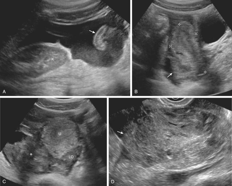 FIG 26-6, Hemoperitoneum from a ruptured ovarian cyst in a nongravid patient. A, Longitudinal image of the right flank demonstrates a large amount of intraperitoneal fluid containing low-level dependent echoes, most consistent with hemoperitoneum surrounding a bowel loop ( arrow ). K, lower pole of the right kidney. B, Longitudinal scan of the pelvis shows the uterus ( calipers ) surrounded by pelvic fluid and echogenic material representing intraperitoneal hemorrhage in the cul-de-sac ( arrow ). C, Transabdominal transverse scan of the pelvis shows a large amount of echogenic material ( asterisk ) in the right adnexa, obscuring the right ovary. LO, left ovary; U, uterus. D, Transvaginal longitudinal scan of the right adnexa shows altered morphologic appearance of the right ovary from a ruptured cyst. Note clotted blood ( arrow ) along the superior aspect of the ovary ( calipers ). The patient was stable at the time of the ultrasound examination, allowing the transvaginal scan to be performed to confirm the suspected diagnosis of a ruptured ovarian cyst with hemoperitoneum.