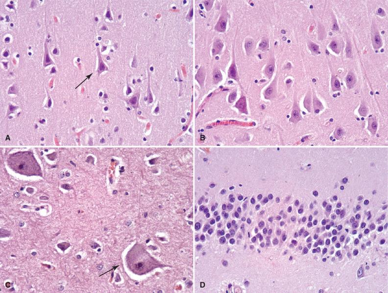 Fig. 2.1, Neurons. (A) Pyramidal neurons (arrow) of the cerebral cortex. (B) Pyramidal neurons of the hippocampus. (C) Betz cells (upper motor neurons) of the motor cortex (arrow). (D) Granular neurons of the dentate fascia of the hippocampal formation. (E) Purkinje cells (arrow) and granular cells (arrowhead) of the cerebellar cortex. (F) Anterior horn cells (lower motor neurons) of the spinal cord. (G) Dopaminergic neurons of the substantia nigra are deeply pigmented due to accumulation of neuromelanin.