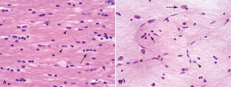 Fig. 2.2, Normal glia. (A) Normal white matter shows oligodendrocytes (arrow), which have round dark nuclei often with a slight perinuclear halo, and astrocytes, with oblong nuclei (arrowheads). Glial cytoplasm blends with the neuropil and cannot typically be noted in the resting state. (B) Cytologic preparation of normal cortex demonstrates normal oligodendrocytes (short arrow), astrocytes (arrowhead), neurons (long arrow), and capillaries (asterisk).