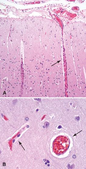 Fig. 2.6, Blood vessels. (A) Large arteries within the subarachnoid space supply the brain by penetrating into the parenchyma, where initially they maintain a perivascular (Virchow-Robin) space that separates the vessel from the neuropil (arrow). (B) Smaller capillaries within the brain (arrows) consist of a thin, delicate tube lined by a single layer of endothelial cells that either directly abut the brain parenchyma or have a smaller perivascular space. The blood-brain barrier is due in large part to the specialized tight junctions between endothelial cells.