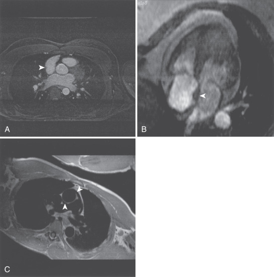 FIG. 15.3, (A) Transverse gradient echo image at the level of the aortic valve obtained using respirator gating with a navigator echo. A right atrial ridge is noted in the lateral wall of the right atrium (arrowhead). This finding is normal and should not be mistaken for a right atrial mass. (B) Single frame from horizontal long-axis balanced steady-state free precession cine cardiovascular magnetic resonance (CMR). Lipomatous hypertrophy of the atrial septum is demonstrated (arrowhead). There is fatty infiltration of the septum that does not involve the region of the fossa ovalis, resulting in the typical “dumbbell” appearance. (C) Oblique double inversion recovery breath-hold CMR image obtained at the level of the right pulmonary artery. The extension of the pericardial space both anterior and posterior to the ascending aorta is demonstrated (arrowheads). The pericardial recess should not be mistaken for evidence of aortic dissection.