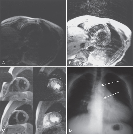 FIG. 15.4, (A) Artifacts due to respiration and poor gating. In this gated spin echo image there is mottling of the ventricular wall and loss of edge sharpness. (B) The same image as in A, but with the window and level adjusted to accentuate the artifact. There are ghosts of the chest wall related to respiratory motion and additional artifact over the heart as a result of poor electrocardiographic gating. (C) Metal artifact. The upper images were obtained with a safety pin present on the anterior subject's gown. The resultant signal void is very evident. The bottom row shows corresponding images after removal of the safety pin. Distortion from metal artifact is markedly more prominent/larger in the gradient recalled echo images (right column) than in the spin echo images (left column). (D) Plain-film x-ray showing sternal wires (dashed arrow) and metallic coronary artery bypass graft (CABG) markers (solid arrow ) in a patient with prior CABG surgery. (E) Artifact from sternal wires (dashed arrow) and CABG markers (solid arrow) on T1-weighted spin echo cardiovascular magnetic resonance imaging. (F) Signal voids (arrows) in two views of a bioprosthetic aortic valve replacement by breath-hold cine balanced steady-state free precession imaging. The artifact results from the nonorganic struts. (G) Metal in bileaflet mitral valve prosthesis produces signal voids (arrows). (H) There is minimal artifact from the tricuspid (dashed arrow) and mitral (solid arrow) annuloplasty rings. (I) Metal artifact from a coronary artery stent in the left anterior descending coronary artery (arrow) seen on a scout image. (J) Chemical shift artifact. The image on the left is done with a relatively short signal acquisition time (wide bandwidth). The image on the right is done with a longer signal acquisition time (narrow bandwidth). This display accentuates the effect of the difference in chemical shift of water and fat, creating the artifactual space between the aortic wall at fat (arrow). (K) Chemical shift artifact in echo planar imaging (EPI). In EPI, the chemical shift artifact occurs in the frequency-encoding direction (right to left in these images). The image on the left is obtained using a multishot EPI sequence with a relatively short EPI acquisition with each shot. The chemical shift artifact is indicated by the white line in the posterior chest wall. The image on the right is obtained using fewer shots with a longer EPI acquisition. The chemical shift is larger, as indicated by the longer white line posteriorly. The image is degraded by superimposition of anterior subcutaneous fat onto the heart. This problem can be addressed by adding fat saturation to the sequence.