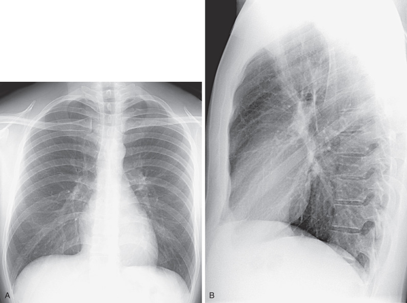 Fig. 1.1, Normal chest radiograph. (A) Posteroanterior projection. (B) Lateral projection.