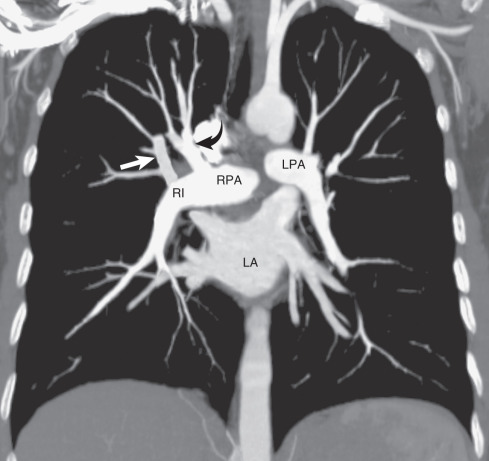 Fig. 1.11, Normal hilar anatomy. A coronal image from a CT scan demonstrates the hilar anatomy as seen on a radiograph. The right pulmonary artery (RPA) is in the mediastinum and therefore not visible on the frontal radiograph. On a frontal radiograph the main shadow of the right hilum is formed by the vertically oriented interlobar artery (RI). Right hilar structures immediately cephalad to the interlobar artery include the ascending pulmonary artery (truncus anterior) (curved arrow) and the right superior pulmonary vein (straight arrow). Most of the left hilum is formed by the distal left pulmonary artery (LPA) and left descending pulmonary artery. LA, Left atrium.