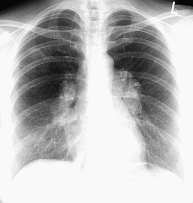 Fig. 1.12, Enlarged bilateral hilar lymph nodes from sarcoidosis. A frontal chest radiograph shows a lobulated contour of the hila and increased size and opacity, findings characteristic of hilar lymph node enlargement. Note that the hilar vessels course through the convex hilar opacities (absence of the hilar convergence sign), indicative of the nonpulmonary artery origin of the hilar opacities.