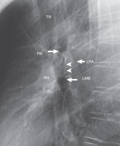 Fig. 1.13, Normal hilar anatomy on a lateral chest radiograph. A magnified view of the hila from a lateral radiograph shows the trachea (TR) tapering off at the level of the carina immediately above the level of the left pulmonary artery (LPA), which is seen as a curved structure as it courses above the left main bronchus (LMB) and continues as the descending left pulmonary artery. The air column of the right upper lobe bronchus (RB) is seen at the level of the carina. The posterior wall of the trachea is continuous with the posterior wall of the right main and bronchus intermedius, which form the intermediate stem line (arrowheads). The right hilum (RH) is located anterior to the right bronchus intermedius.