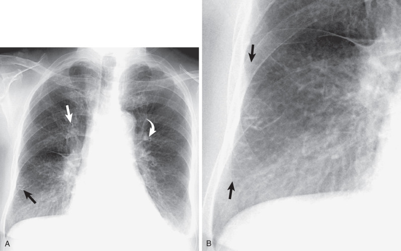 Fig. 1.15, Thickening of the interlobular septa in interstitial pulmonary edema. (A) A frontal chest radiograph in a patient with left heart failure and interstitial pulmonary edema shows septal (Kerley B) lines (black arrow). Also noted is bronchial cuffing as a result of edema (straight arrow) and increased size of the anterior segmental left upper lobe pulmonary artery (curved arrow), which has a greater diameter than the adjacent bronchus does. Also noted are small bilateral pleural effusions. (B) A magnified view of the right lower lung region better demonstrates the septal lines (arrows).