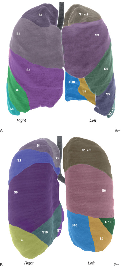 Fig. 1.16, (A) Pulmonary lobes and segments: anterior view. A schematic drawing superimposed on a three-dimensional surface reformatted image obtained with a multidetector CT scanner shows the location of the pulmonary segments and lobes on the anterior surface of the right and left lungs. The segments that form the anterior surface of the right lung include the apical (S1) and anterior (S3) segments of the right upper lobe, the lateral (S4) and medial (S5) segments of the right middle lobe, and the anterior basal (S8) segment of the right lower lobe. The anterior view of the left lung shows the location of the apicoposterior segment (S1 + 2), anterior (S3) segment, and superior (S4) and inferior (S5) lingular segments of the left upper lobe, as well as the anteromedial basal (S7 + S8) segment. Because the heart was removed from the original image, the lateral basal (S9) and posterior basal (S10) segments of the left lower lobe are also demonstrated on this image. (B) Pulmonary lobes and segments: posterior view. The segments that form the posterior surface of the right lung include the apical (S1), posterior (S2), and anterior (S3) segments of the right upper lobe and the superior (S6), lateral basal (S9), posterior basal (S10), and (adjacent to the heart, which is not shown) medial ( S7) basal segments of the right lower lobe. The segments that form the posterior surface of the left lung include the apicoposterior (S1 + S2) segments of the left upper lobe and the superior (S6), anteromedial basal (S7 + S8), lateral basal (S9), and posterior basal (S10) segments of the left lower lobe.