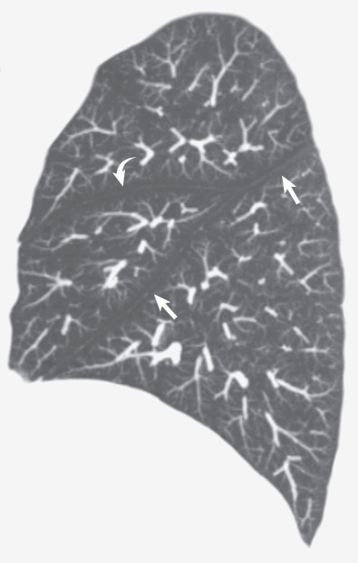 Fig. 1.17, Normal right interlobar fissures. A sagittal maximum-intensity projection image obtained from a CT scan shows normal position of the right major (straight arrows) and minor (curved arrow) interlobar fissures.