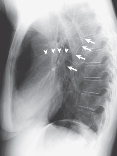 Fig. 1.18, Normal major and minor fissures. Lateral radiograph showing the right major (arrows) and minor (arrowheads) fissures. The left major fissure normally projects slightly posterior to the right major fissure and is not well seen on this radiograph.