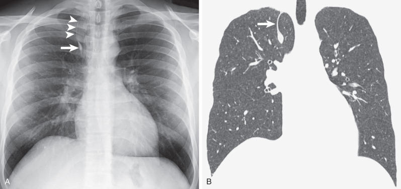 Fig. 1.19, Azygos fissure. (A) Posteroanterior chest radiograph showing the azygos fissure as a curvilinear line (arrowheads) extending obliquely across the upper portion of the right lung. Note the azygos vein (arrow) coursing within the fissure. (B) Coronal reformatted image from a CT scan showing the azygos fissure (arrow).