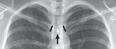 Fig. 1.2, Properly centered chest radiograph. A view from a frontal radiograph shows that the medial ends of the right and left clavicles (highlighted in black) are equidistant to the spinous process (arrow) of the vertebra at the same level, thus indicating that the radiograph is properly centered.