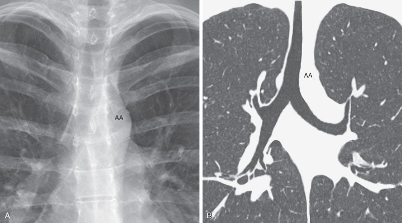 Fig. 1.3, Normal trachea and main bronchi. (A) Frontal radiograph shows that the tracheal air column is fairly straight and located in the midline except at the level of the aortic arch (AA), where the trachea is indented and may be slightly deviated to the right. The trachea divides into a short right main bronchus and a longer and more horizontal left main bronchus. (B) Coronal reformatted image from a CT scan demonstrating the normal anatomy of the trachea, the slight indentation at the level of the aortic arch (AA), and the main bronchi. Approximately 2 cm after its origin, the right main bronchus branches into the right upper lobe bronchus and the bronchus intermedius.