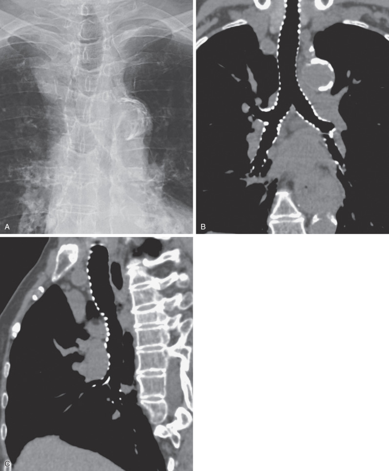 Fig. 1.4, Tracheal and bronchial wall calcification. A magnified view from a posteroanterior chest radiograph (A) in an elderly patient shows calcification of the tracheal and bronchial walls. Coronal (B) and sagittal (C) reformatted images from a CT scan show the extent of tracheal and bronchial calcification. Airway wall calcification is a normal finding in elderly patients.