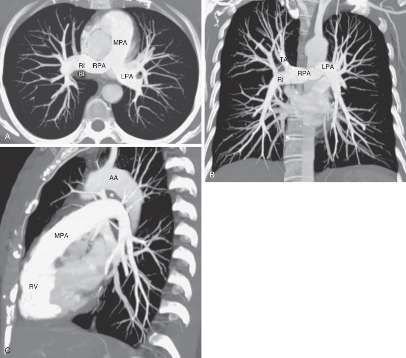 Fig. 1.6, Normal anatomy of the central pulmonary arteries. (A) A maximum-intensity projection image obtained from a CT scan demonstrates that the main pulmonary artery (MPA) courses posteriorly and branches into the right (RPA) and left (LPA) pulmonary arteries. The right pulmonary artery branches shortly after its origin into the truncus anterior, which courses cephalad to supply most of the right upper lobe, and a larger right interlobar pulmonary artery (RI), which courses just anterior and then lateral to the bronchus intermedius (BI). (B) Coronal image from a CT scan demonstrating the orientation of the RPA and LPA in the same projection as the frontal radiograph. The right pulmonary artery and the central portion of the left pulmonary artery are in the mediastinum and therefore cannot be identified on the chest radiograph. The right pulmonary artery branches into the truncus anterior (TA) and RI . (C) Sagittal image demonstrating the orientation of the right and left pulmonary arteries that corresponds to the lateral chest radiograph. The MPA originates from the right ventricle (RV) and courses cephalad and posteriorly. AA, Aortic arch; asterisk, aortopulmonary window.