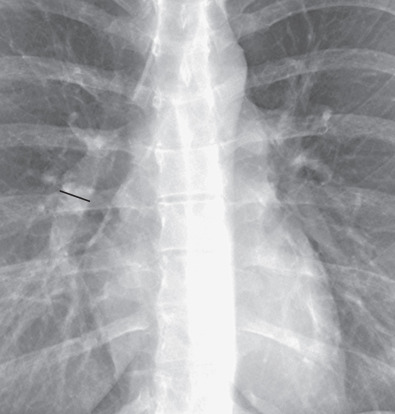 Fig. 1.7, Normal right interlobar artery visualized on a frontal chest radiograph. The upper limit of normal of the transverse diameter of the interlobar artery measured from its lateral aspect to the air column of the bronchus intermedius (black bar) is 16 mm in men and 15 mm in women.