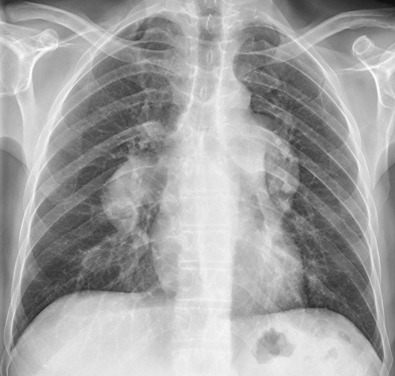 Fig. 1.8, Enlarged central pulmonary arteries from severe pulmonary arterial hypertension. A frontal radiograph shows markedly enlarged central pulmonary arteries.