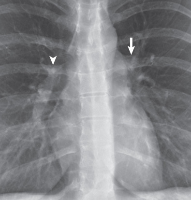 Fig. 1.10, Normal hila. A view from a frontal radiograph shows that the main shadow of the right hilum is formed by the vertically oriented interlobar artery (arrowhead) and that of the left hilum by the distal left pulmonary artery (right arrow) and descending left pulmonary artery. Because the left pulmonary artery arches above the left main and left upper lobe bronchi, the left hilum is normally 1–2 cm higher than the right hilum.