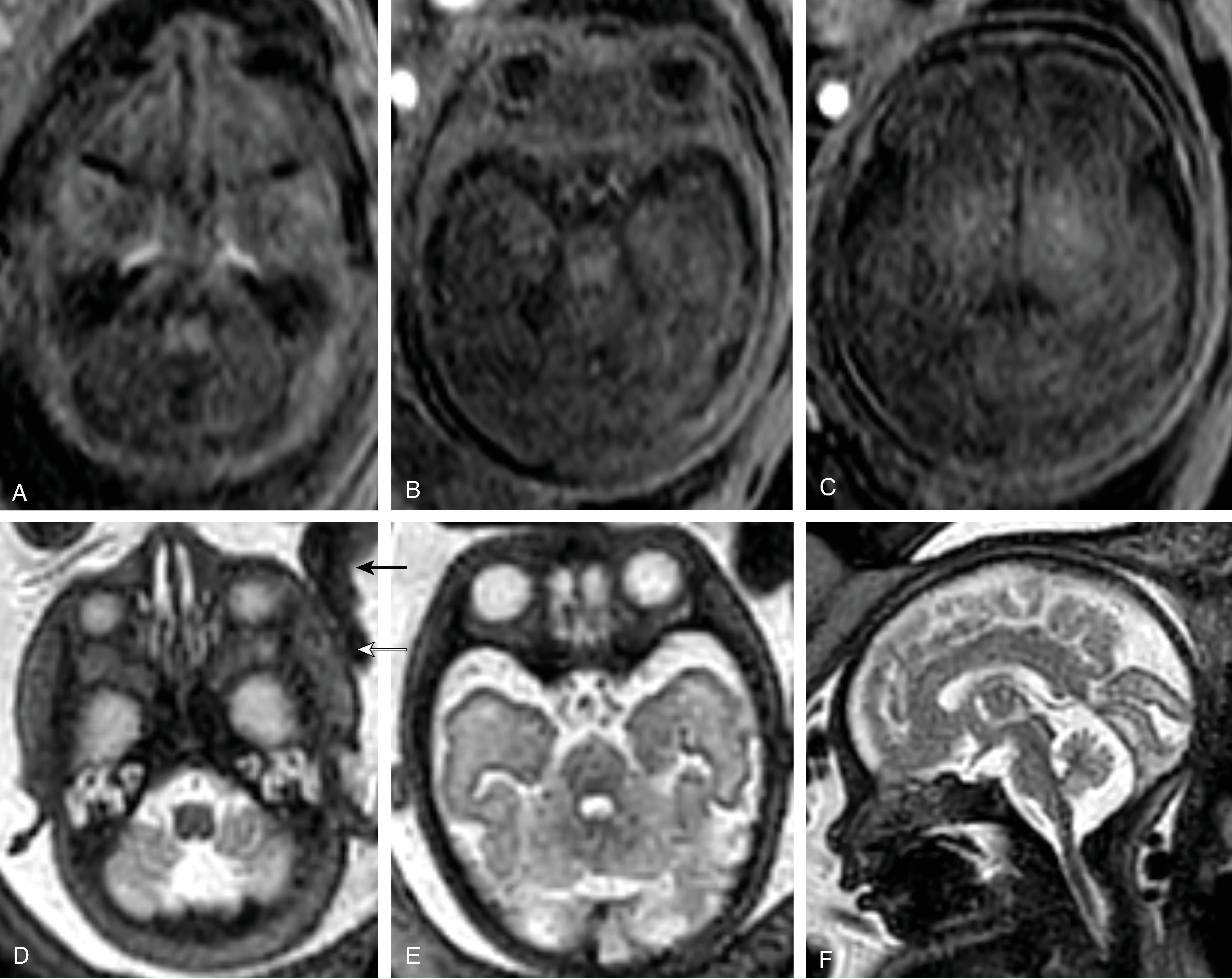 Fig. 1.4, Myelination on Fetal MRI at 34 Weeks’ Gestation .