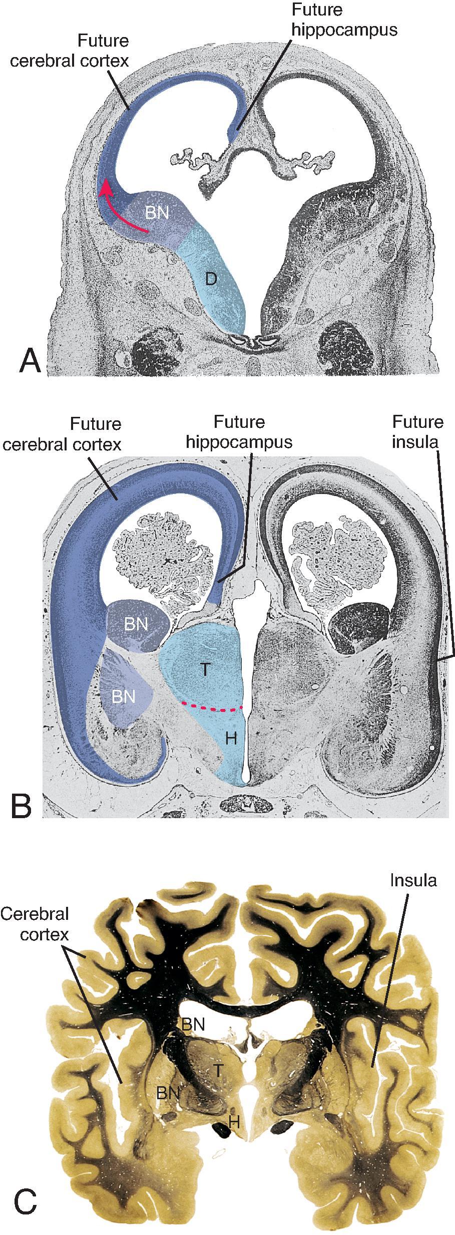 Fusion between the diencephalon and telencephalon as the cerebral hemispheres enlarge. (A) During the second month, the telencephalic vesicles, including zones that will become the cerebral cortex and basal nuclei (BN) , are separate from but continuous with the diencephalon (D) and its cavity. As a result of subsequent rapid telencephalic growth, the basal nuclei portion folds down toward the diencephalon. At the end of the third month (B), the telencephalon and diencephalon have fused. After further rapid growth, the insula, overlying the point of fusion, becomes overgrown by other cerebral cortex in the adult brain (C). H , Hypothalamus; T , thalamus. (A and B from Hochstetter F. Beiträge zur Entwicklungsgeschichte des menschlichen Gehirns . I. Teil, Vienna, 1919, Franz Deuticke. C from Vanderah TW, Gould DJ, Nolte J, eds. Nolte’s The Human Brain: An Introduction to Its Functional Anatomy. 8th ed. Elsevier; 2021.)