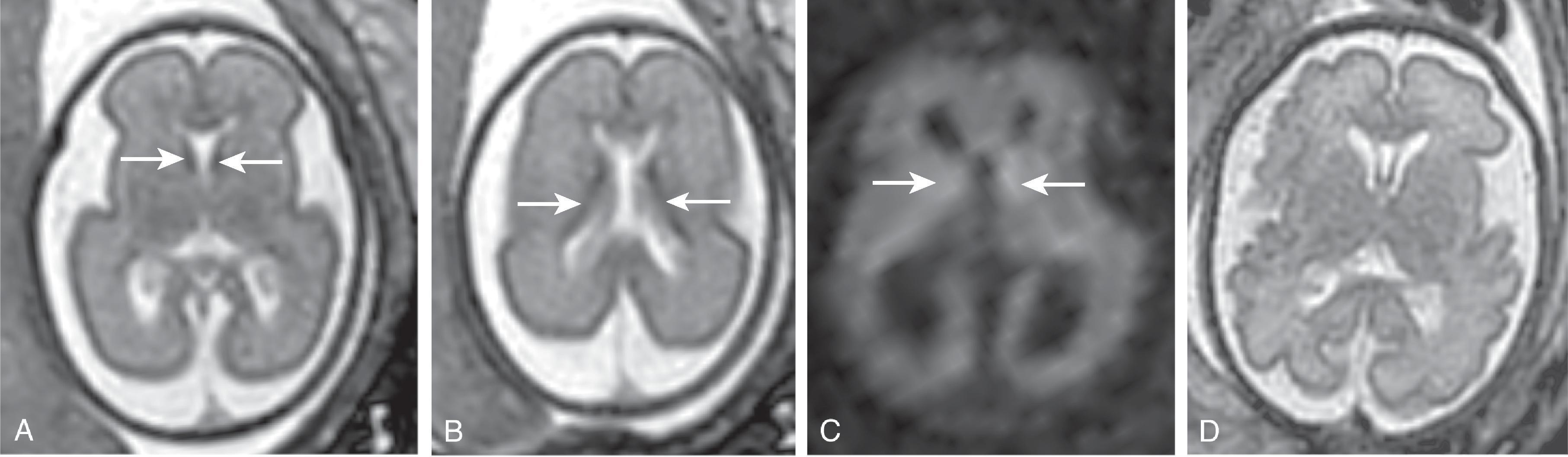 Fig. 1.2, Normal Germinal Matrix .