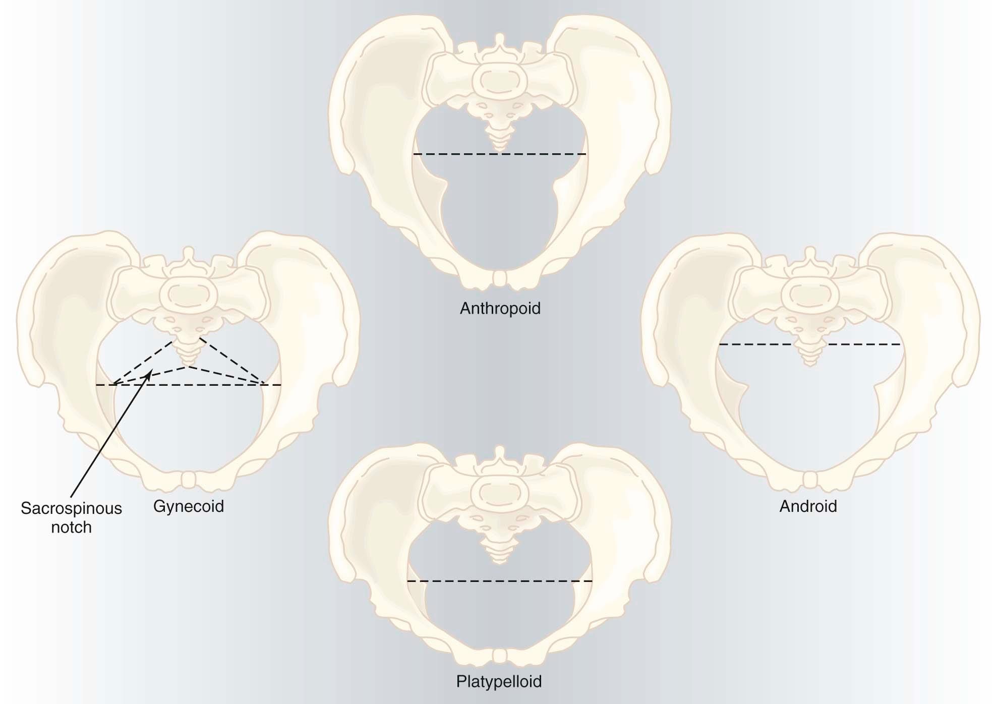 FIGURE 8-5, The four basic pelvic types. The dashed lines indicate the transverse diameter of the inlet . Note that the widest diameter of the inlet is posteriorly situated in an android or anthropoid pelvis. The gynecoid pelvis illustrates the location of the sacrospinous notch, present in all pelvic types.