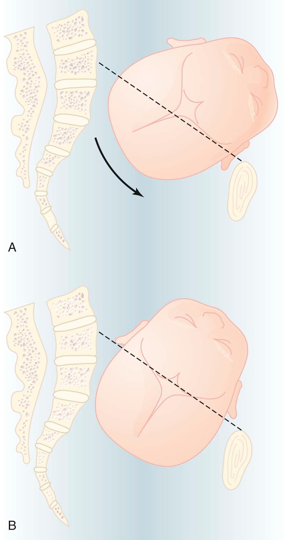 FIGURE 8-6, Anterior asynclitism entering the pelvis (A) and synclitism in the pelvis (B). The curved arrow shows the direction to correct asynclitism, and the dashed lines show the axis that defines synclitism.