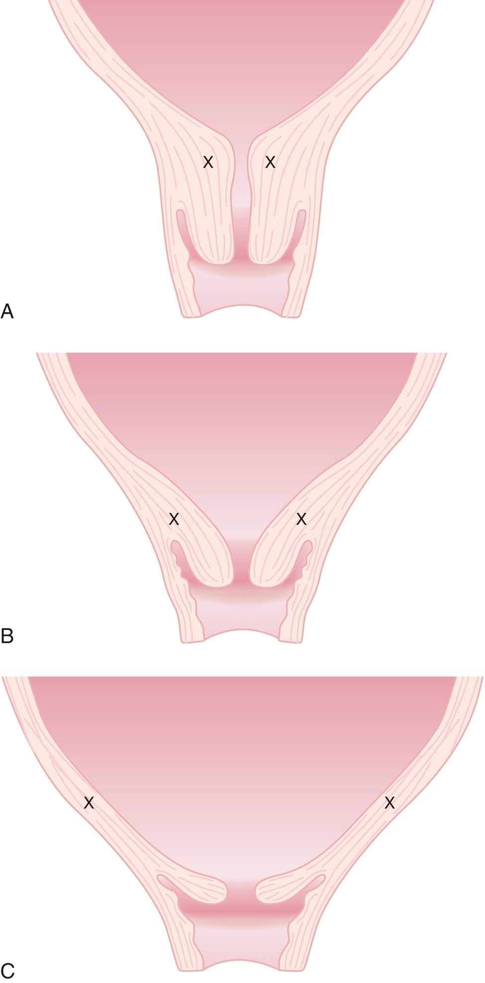 FIGURE 8-8, A, The absence of cervical effacement before labor ( X shows the location of the internal os in a normal cervix). B, Cervical os (X) being progressively taken up into the lower segment of the uterus (about 50% effaced). C, Cervical os (X) fully taken up (cervix is completely effaced).