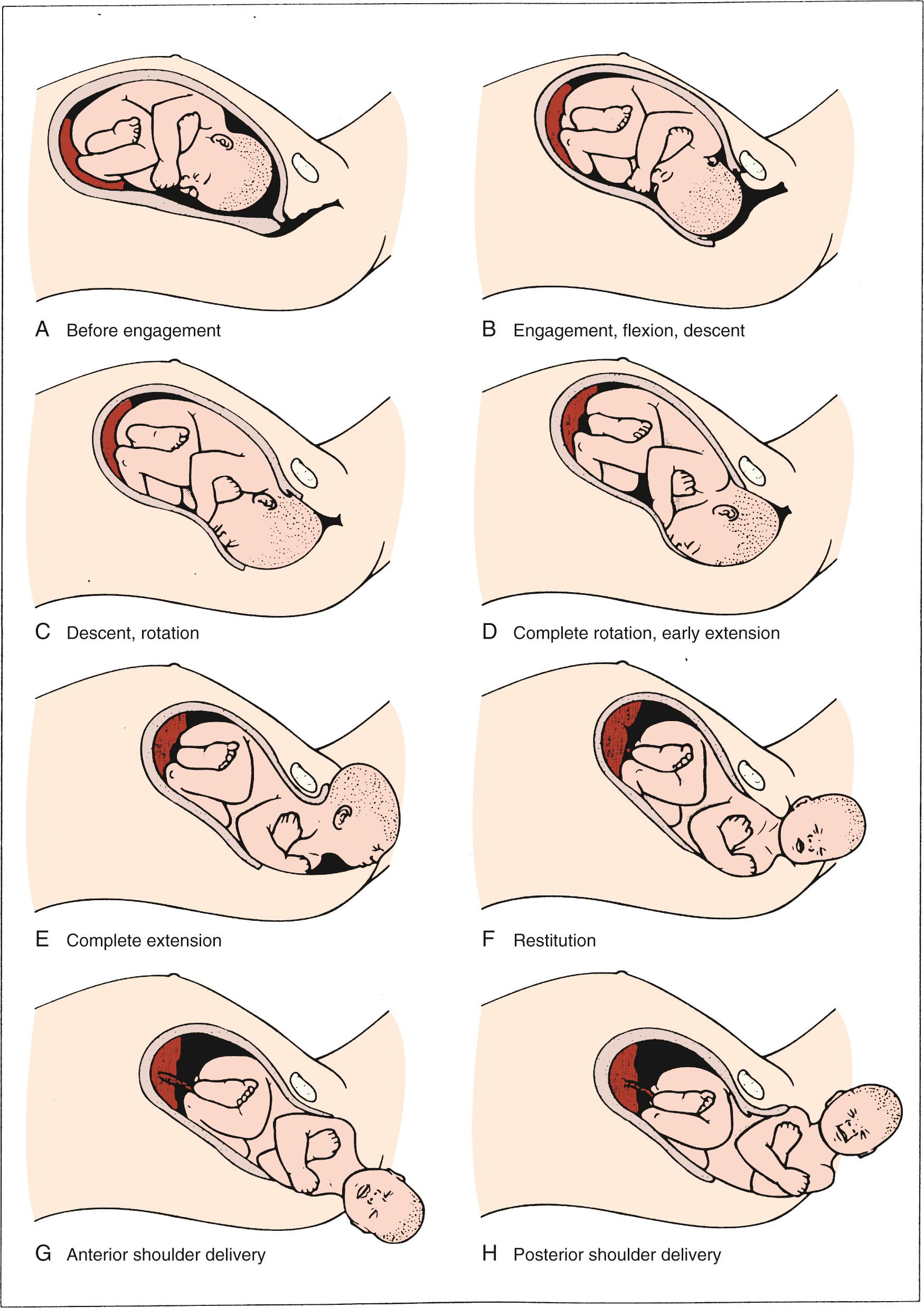 Fig. 11.11, Cardinal Movements of Labor.