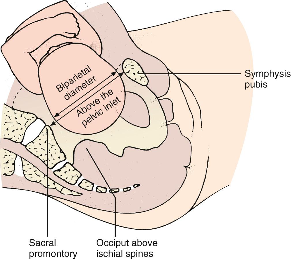 Fig. 11.12, Engagement of the Fetal Head.