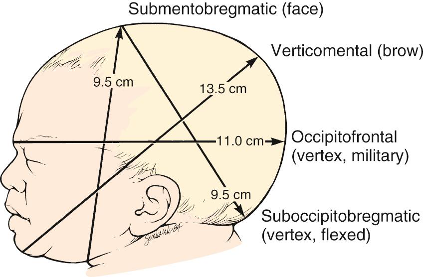 Fig. 11.5, Presenting Diameters of the Average Term Fetal Skull.