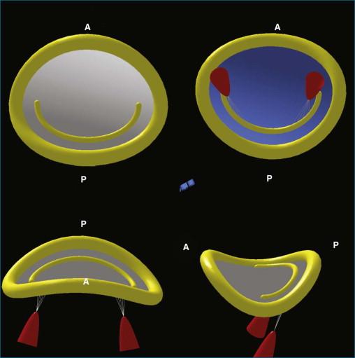 Figure 5-2, The mitral value annulus as a hyperbolic paraboloid with anterior ( A ) and posterior ( P ) peaks that are higher than the plane containing the commissures. In this figure, the papillary muscles are in red. The top left image shows the annulus from the left atrial side. The top right image demonstrates the annulus from the left ventricular view.