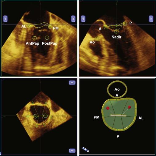 Figure 5-3, A computer rendition of the mitral value annulus ( bottom left ) obtained by identifying key annular structures on a three-dimensional full-volume dataset cropped to form several different views (two-chamber view at the top left, long-axis view on the top right, and a short-axis view on the bottom left ). A, anterior; AL, anterolateral commissure; AntPap, anterior papillary muscle; Ao, aorta; P, posterior; PM, posteromedial commissure; PostPap, posterior papillary muscle.