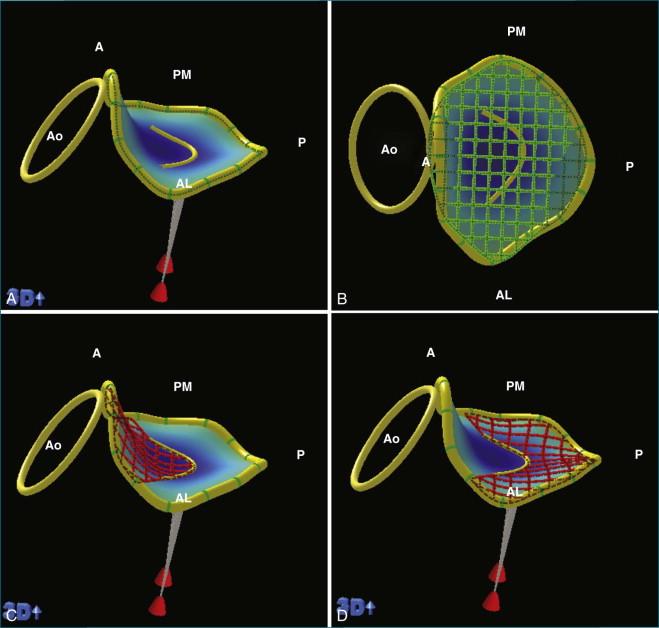 Figure 5-4, Computer renditions allow key measurements, including annular circumference ( A ); annular area ( B ); anterior leaflet area ( C ); posterior leaflet area ( D ); annular height, commissural distance, and anteroposterior distance ( E ); and aortic-mitral angle ( F ). A, anterior; AL, anterolateral; Ao, aortic valve; P, posterior; PM, posteromedial.