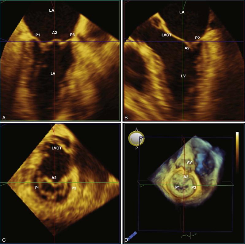 Figure 5-6, Demonstration of the mitral valve leaflets obtained from a three-dimensional full-volume data-set. Multiplane reconstructions are shown in A through C. The on-face view of the leaflets from the left atrium ( LA ) is shown in D. LV, left ventricle; LVOT, left ventricular outflow tract; A2, P1, P2, and P3, scallops of the mitral valve leaflets.