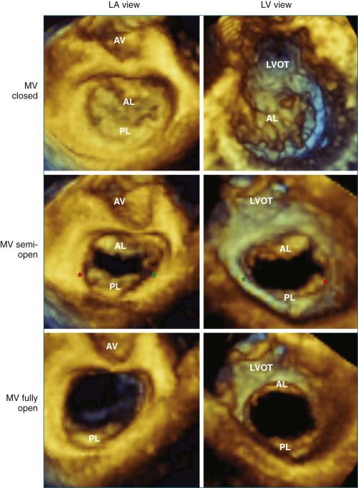 Figure 5-7, The mitral valve ( MV ) leaflets from three-dimensional wide-sector datasets obtained during a transesophageal exam. The leaflets are viewed from the left atrium ( LA ) on the left and from the left ventricle ( LV ) on the right . Red asterisk , anterolateral commissure; green asterisk , posteromedial commissure; AL , anterior leaflet; AV , aortic valve; LVOT , left ventricular outflow tract; PL , posterior leaflet.